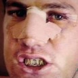 Take a good look at this face. It’s what happened to Australian sportsman Simon Cowley when he fell foul of champion swimmer, Nick D’Arcy, in a bar altercation shortly before the 2008 Beijing Olympic Games. D’Arcy king-hit Cowley, inflicting so much damage that his features had to be surgically rebuilt. Take another good look at this face. Because this is...